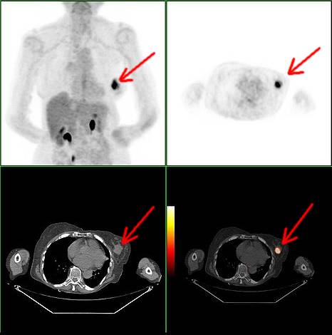 Arrow points to Breast Cancer on  PET SCAN