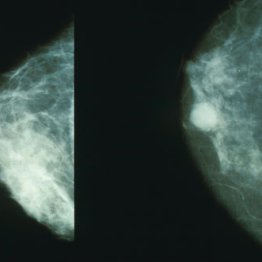 Mammobreastcancer
