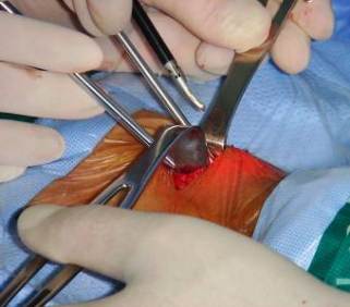 Video_Assisted_Thyroidectomy