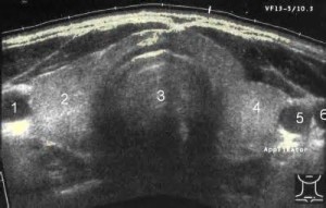 Ultrasound Image of Thyroid Gland