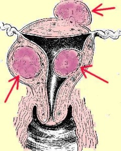 Uterine Fibroids Ovarie Hysterectomy