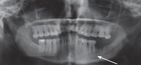 Fosamax induced osteonecrosis of jaw AFP 2012