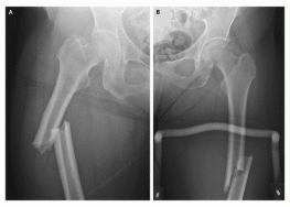 femur fracture on alendronate
