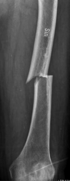 incidence of femoral shaft fracture in women treated with bisphoshonates