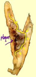 Gross-Pathology-Carotid-Plaque