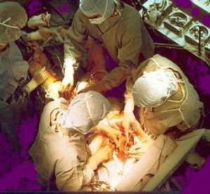 Coronary_artery_bypass_surgery_bioidentical