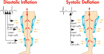 Sequential_Inflation_And_Deflation_Of_Leg_Cuffs_During_Vasomedical_EECP®_Therapy