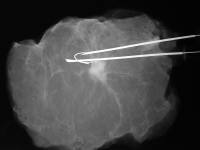 breast cancer needle localization specimen