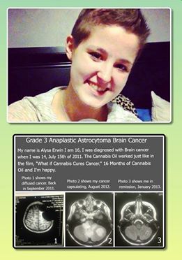 Alysa erwin MRI Astrocytoma cannabis