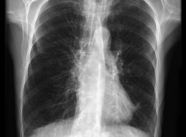 COPD-Radiopedia