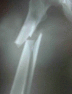 Spontaneous-mid-femur-fracture-courtesy-of-Jennifer-P.-Schneider