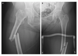 femur-fracture-on-alendronate
