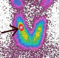RadionuclideScanTechnesium99MThyroidHotNodule99drjeffreydach