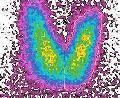 Technesium-99M-Radionuclide-Scan-of-Throid-Gland