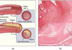 Atherosclerosis-Plaque-Wikimedia