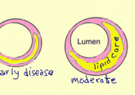 atherosclerosis_9a2